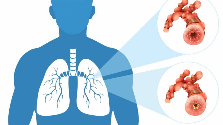 Conheça os sintomas de tuberculose