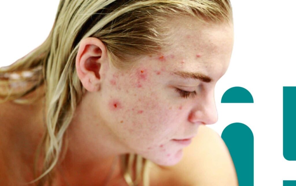 rosto feminino com acne