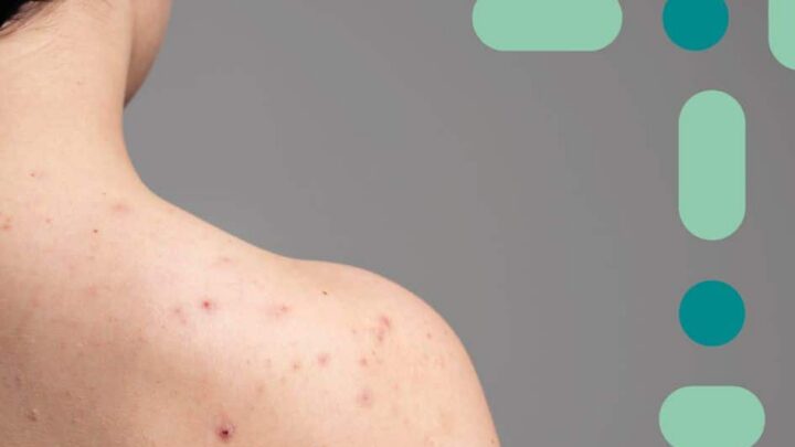 Qual o motivo das espinhas pelo corpo? Entenda!